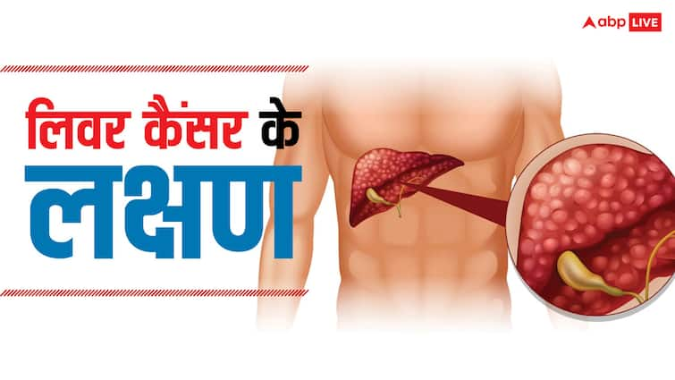 liver Cancer symptoms signs causes and treatment read full article in hindi